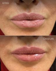 Aumento de labios