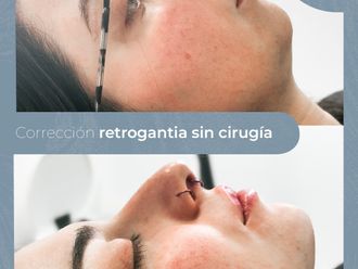 Aumento mentón antes y después - 875373