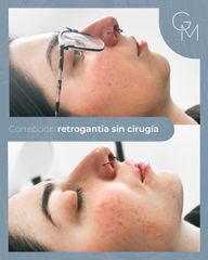 Aumento de mentón