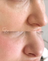Rinoplastia