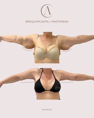 Braquioplastia + Mastopexia