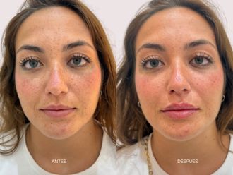 Aumento labios antes y después - 875686
