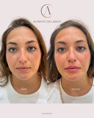 Aumento de labios