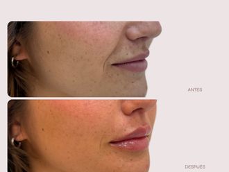 Aumento labios antes y después - 875687