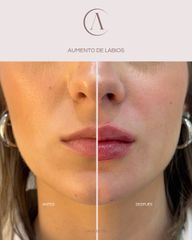 Aumento de labios