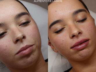 Aumento labios antes y después - 875689