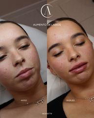 Aumento de labios
