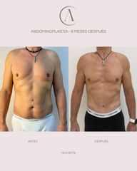 Abdominoplastia