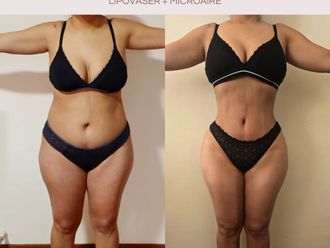 Lipo Vaser antes y después - 875693