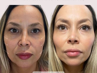 Rejuvenecimiento facial antes y después - 875694