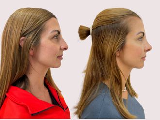 Rinoplastia antes y después - 875695