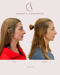 Rinoplastia