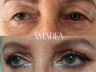 Blefaroplastia antes y después - 877598