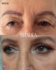 BLEFSROPLASTIA COMPLETA - Amadea Clinic SL