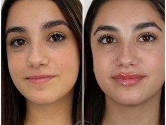 Aumento labios antes y después - 877599