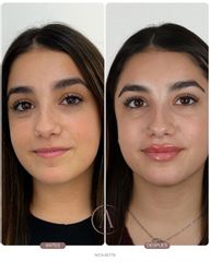 AUMENTO DE LABIOS - Amadea Clinic SL