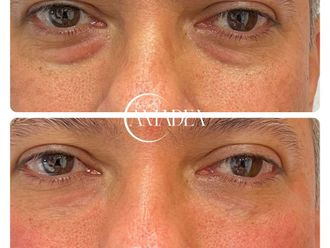 Eliminación ojeras antes y después - 877600