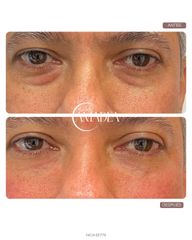 TRATAMIENTO DE OJERAS - Amadea Clinic SL