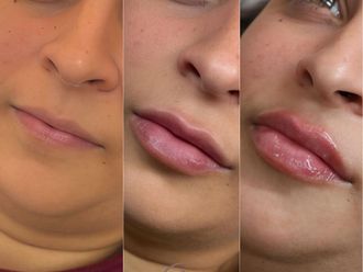 Aumento labios antes y después - 877601