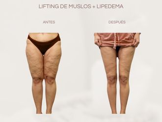 Lipedema antes y después - 877602