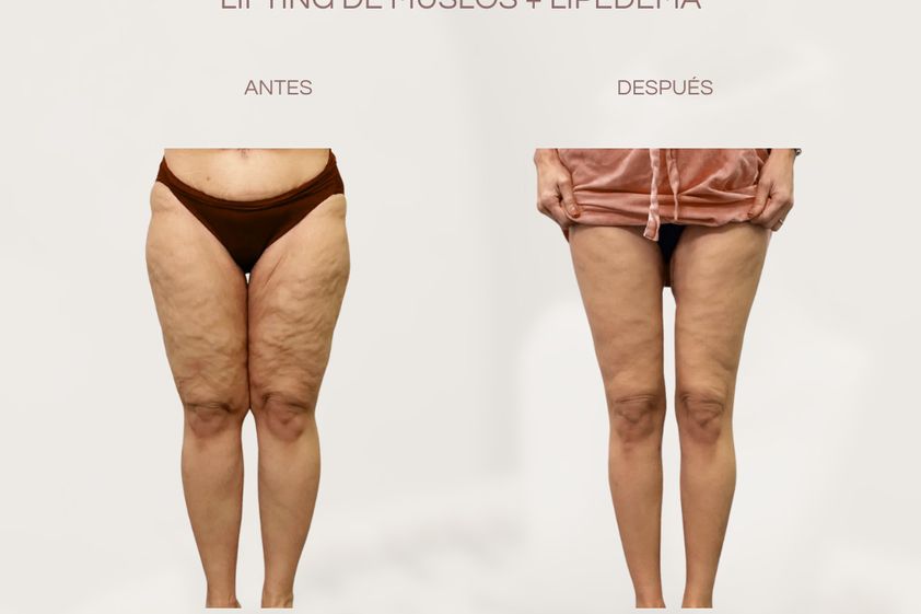 Lipedema antes y después - 877602