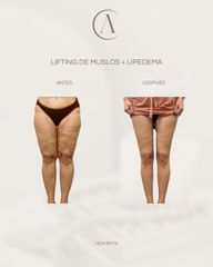 CIRUGIA DE LIPEDEMA Y LIFTING DE MUSLOS - Amadea Clinic SL