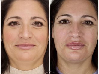 Aumento labios antes y después - 877603