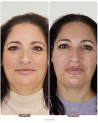 AUMENTO DE LABIOS - Amadea Clinic SL