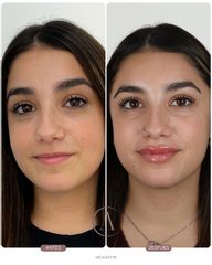 Amadea Clinic SL - Aumento de labios
