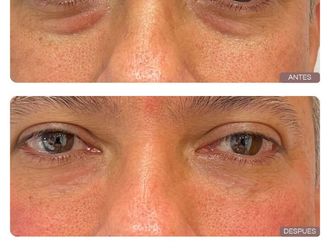 Eliminación ojeras antes y después - 877833