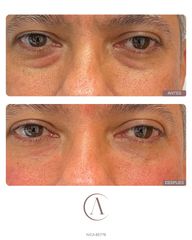 Amadea Clinic SL - Eliminación de ojeras