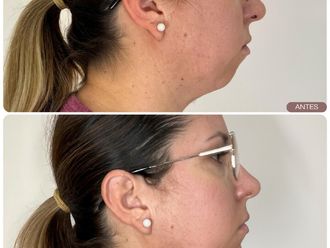 Aumento mentón antes y después - 877835