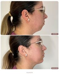Aumento de mentón con 1 vial: equilibrio facial en su justa medida ✨