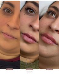 Aumento de labios: un gesto que redefine la expresión