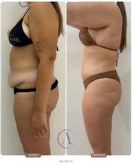 Abdominoplastia + LipoVASER en abdomen y cintura + Mastopexia | 3 meses de evolución