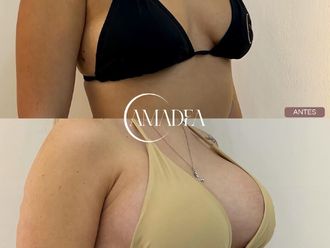 Lipo Vaser antes y después - 877839