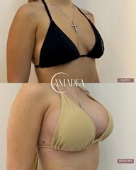 Abdominoplastia + LipoVASER en abdomen y cintura + Mastopexia