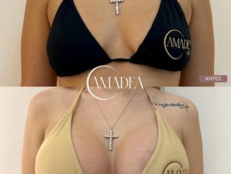 Aumento de pecho antes y después - 877900