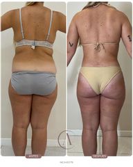 Abdominoplastia + LipoVASER y MicroAire 360 | Abdomen, cintura y espalda 🤎