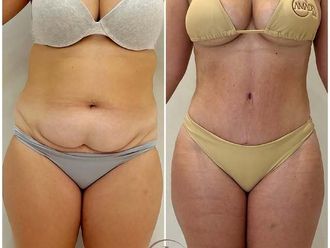 Lipo Vaser antes y después - 877902