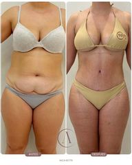 Abdominoplastia + LipoVASER y MicroAire 360 | Abdomen, cintura y espalda 🤎
