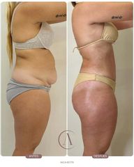 Abdominoplastia + LipoVASER y MicroAire 360 | Abdomen, cintura y espalda 🤎