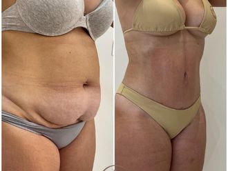 Lipo Vaser antes y después - 877944