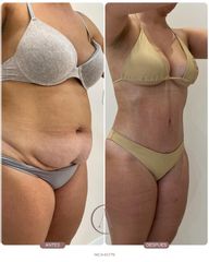 Abdominoplastia + LipoVASER y MicroAire 360 | Abdomen, cintura y espalda 🤎