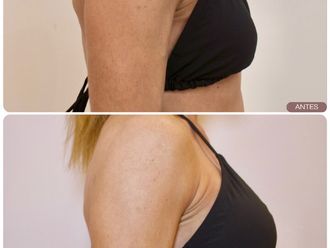 Aumento de pecho antes y después - 877945