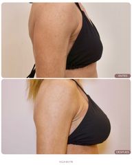 El aumento de pecho es una decisión personal que va más allá del volumen: busca equilibrio, proporci