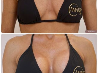 Aumento de pecho antes y después - 877946