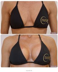 El aumento de pecho es una decisión personal que va más allá del volumen: busca equilibrio, proporci