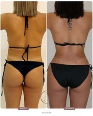Recambio de implantes + Lipoescultura: renovación y armonía corporal ✨