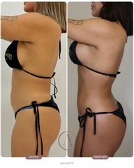 Recambio de implantes + Lipoescultura: renovación y armonía corporal ✨